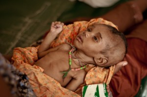 malnutrition-in-children-in-india-and-africa